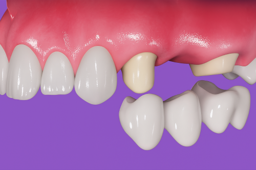 Prótesis dental 3